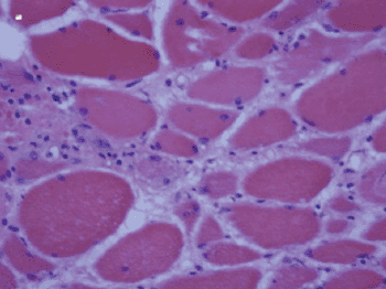 Image: Severe statin-associated necrotizing myopathy (Photo courtesy of Dr. Steven K. Baker.